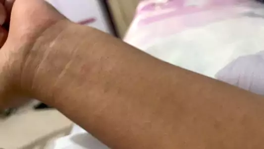 轻度热痱（痱子）的治疗方法：西药软膏 中药外洗等